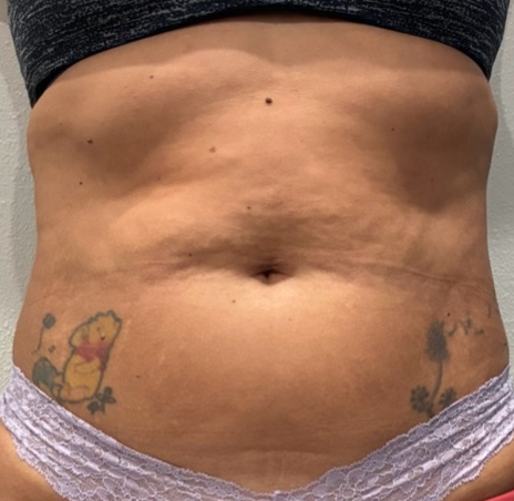 Flat-Stomach Core Reset - before