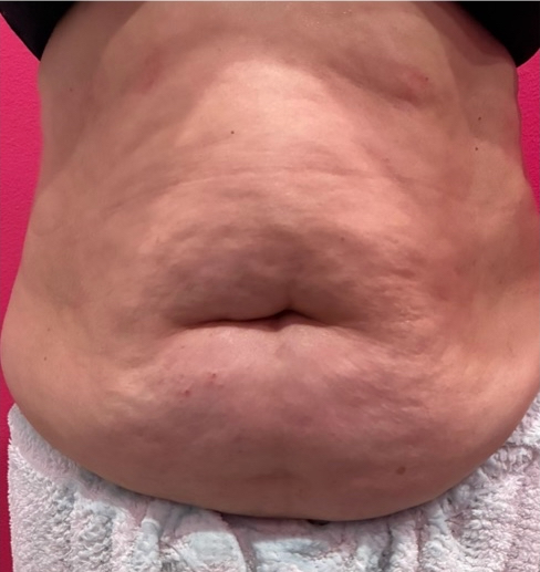 Gut Relief + Major Core Volume Drop - before