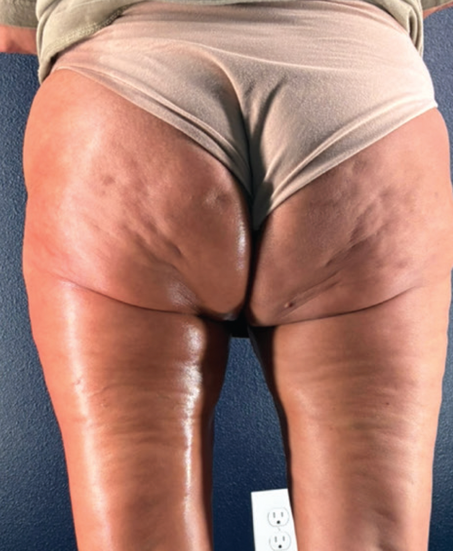 Non-Invasive Glute Lift + Smoother Cellulite - before