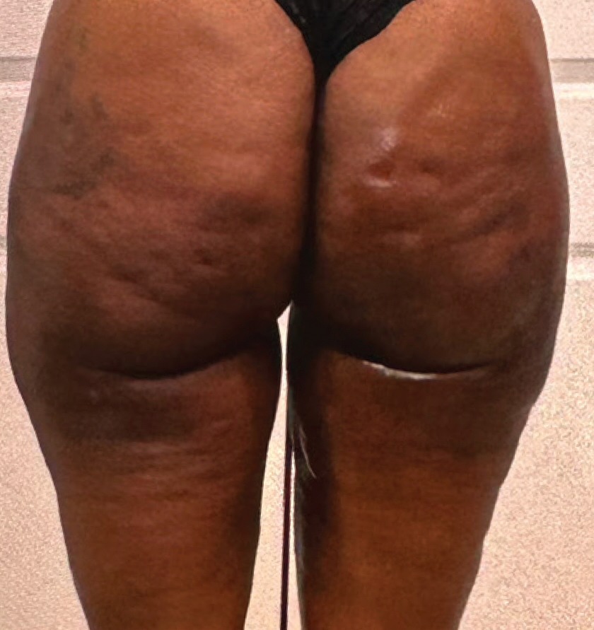 Shape Lift + Dimple Smoothing - before