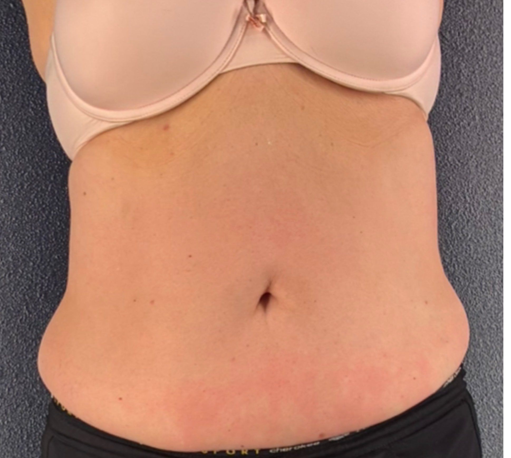 30-Day Lymphatic Reset + Core Sculpt - after