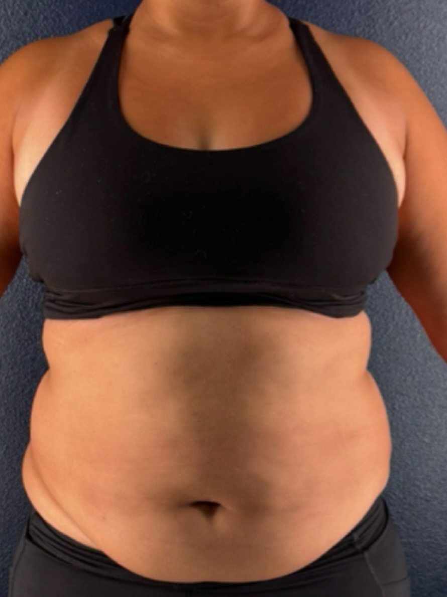 12-Month Total Body Transformation - before